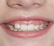 before image of 13 year old girl Close-up of smile with crowded and misaligned teeth, showing an uneven bite and irregular spacing