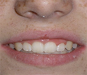 before image of 13 year old girl Close-up of smile with crowded and misaligned teeth, showing an uneven bite and irregular spacing