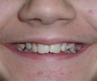 before image of smile showing misaligned and uneven teeth of 15 year old girl