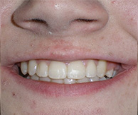 before image of smile showing misaligned and uneven teeth of 15 year old girl