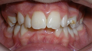 before image of 15 year old girl teeth showing severe misalignment, crowding, and uneven spacing