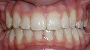 before image of 15 year old girl teeth showing severe misalignment, crowding, and uneven spacing