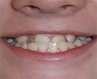 before image of 12 year old girl Close-up of smile showing crowded, misaligned teeth with noticeable gaps and overlapping incisors