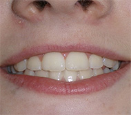 before image of 12 year old girl Close-up of smile showing crowded, misaligned teeth with noticeable gaps and overlapping incisors