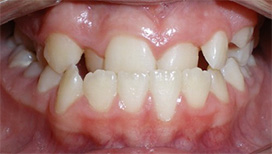 before image of 12 year old girl Close-up of teeth showing severe crowding, misalignment, and noticeable gaps between upper front teeth