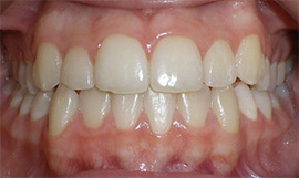 before image of 12 year old girl Close-up of teeth showing severe crowding, misalignment, and noticeable gaps between upper front teeth