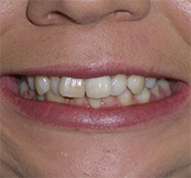 before image of 23 year old woman Close-up of smile with misaligned, crowded teeth, noticeable uneven spacing, and irregular positioning of the lower teeth