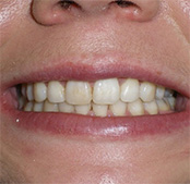 before image of 23 year old woman Close-up of smile with misaligned, crowded teeth, noticeable uneven spacing, and irregular positioning of the lower teeth