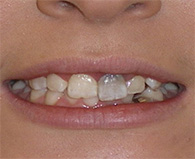 before image of 21 year old girl Close-up of smile showing severely misaligned, discolored, and decayed teeth