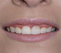 before image of 21 year old girl Close-up of smile showing severely misaligned, discolored, and decayed teeth