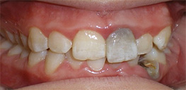 Close-up of a person's teeth showing severe discoloration, misalignment, and a decayed tooth