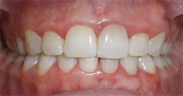 Close-up of a person's teeth showing severe discoloration, misalignment, and a decayed tooth