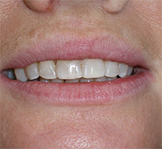 before image of 48 year old woman Close-up of mouth showing misaligned and chipped teeth