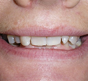 before image of 48 year old woman Close-up of mouth showing misaligned and chipped teeth