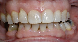 before image of 48 year old woman close up of smile showing uneven and slightly discoloured teeth with an overbite