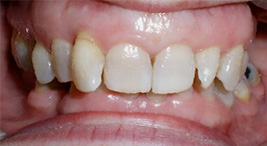 before image of 48 year old woman close up of smile showing uneven and slightly discoloured teeth with an overbite