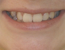 before image of 13 year old girl Close-up image of smile showing mild crowding and misalignment of teeth