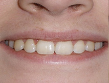 before image of 13 year old girl Close-up image of smile showing mild crowding and misalignment of teeth