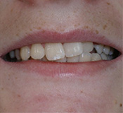 before image of 14 year old boy Close-up of smile showing teeth discoloration and dental issues before treatment, demonstrating need for cosmetic dental work