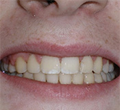 before image of 14 year old boy Close-up of smile showing teeth discoloration and dental issues before treatment, demonstrating need for cosmetic dental work