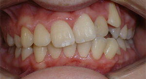 before image of 14 year old boy Close-up image of teeth showing significant crowding and misalignment of both upper and lower teeth