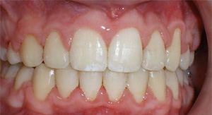 before image of 14 year old boy Close-up image of teeth showing significant crowding and misalignment of both upper and lower teeth