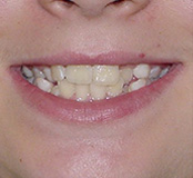 before image of 11 year old girl Close-up image of smile showing crowded and misaligned teeth