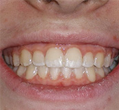 before image of 11 year old girl Close-up image of smile showing crowded and misaligned teeth