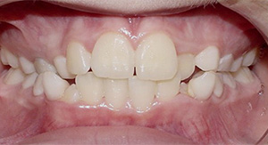 before image of 11 year old girl Close-up image of teeth showing misalignment, crowding, and an overbite