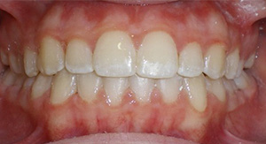 before image of 11 year old girl Close-up image of teeth showing misalignment, crowding, and an overbite