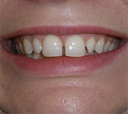 before image of 41 year old woman teeth showing a noticeable gap between the two upper front teeth and mild crowding of the side teeth