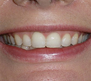 before image of 41 year old woman teeth showing a noticeable gap between the two upper front teeth and mild crowding of the side teeth