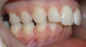 before image of 41 year old woman teeth showing significant misalignment, crowding of the lower teeth, and an overbite