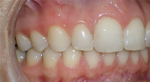 before image of 41 year old woman teeth showing significant misalignment, crowding of the lower teeth, and an overbite