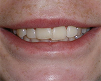 before image of 14 year old boy smile showing slightly misaligned front teeth with mild spacing issues