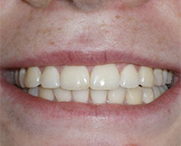 before image of 14 year old boy smile showing slightly misaligned front teeth with mild spacing issues