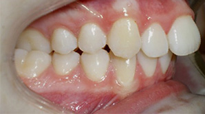 before image of 14 year old boy teeth from a side view, showing an overbite and dental misalignment