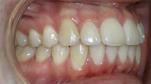 before image of 14 year old boy teeth from a side view, showing an overbite and dental misalignment