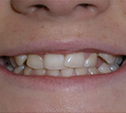 before image of 14 year old girl Close-up of smile showing crooked and overlapping front teeth with uneven alignment