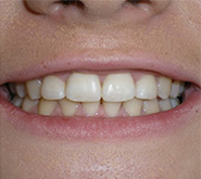 before image of 14 year old girl Close-up of smile showing crooked and overlapping front teeth with uneven alignment