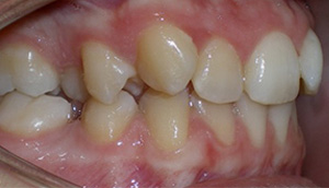 before image of 14 year old girl Side view of teeth showing malocclusion with severe overbite and misalignment