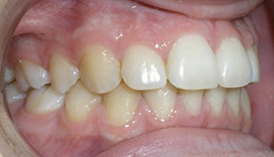 before image of 14 year old girl Side view of teeth showing malocclusion with severe overbite and misalignment