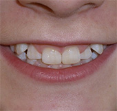 before image of 14 year old girl smile showing misaligned front teeth with noticeable gaps and crowding