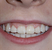 before image of 14 year old girl smile showing misaligned front teeth with noticeable gaps and crowding