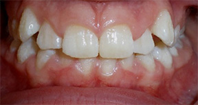 before image of 14 year old girl teeth showing severe crowding and misalignment of the upper and lower front teeth