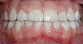 before image of 14 year old girl teeth showing severe crowding and misalignment of the upper and lower front teeth