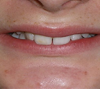 before image of 12 year old girl Close-up image of smile showing slight misalignment, minor spacing, and a discolored front tooth