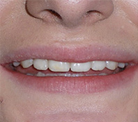 before image of 12 year old girl Close-up image of smile showing slight misalignment, minor spacing, and a discolored front tooth