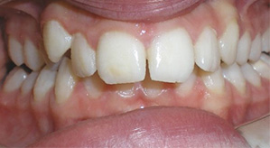 before image of 12 year old girl Close-up frontal view of teeth showing significant misalignment, spacing issues, and an overbite with crowding of the lower teeth