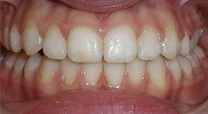 before image of 12 year old girl Close-up frontal view of teeth showing significant misalignment, spacing issues, and an overbite with crowding of the lower teeth